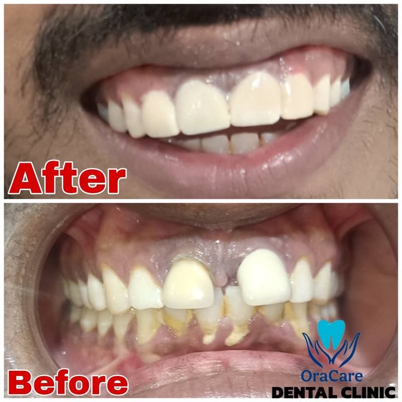 Crown and bridge dental restoration before and after