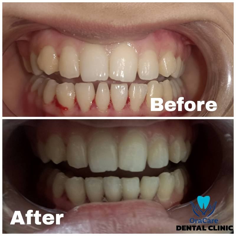 Gum treatment before and after at OraCare Dental Clinic