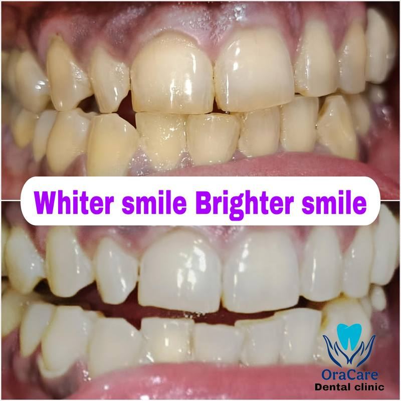 Teeth whitening before and after results
